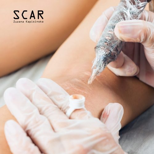 Scar camouflage treatment with special rotative device